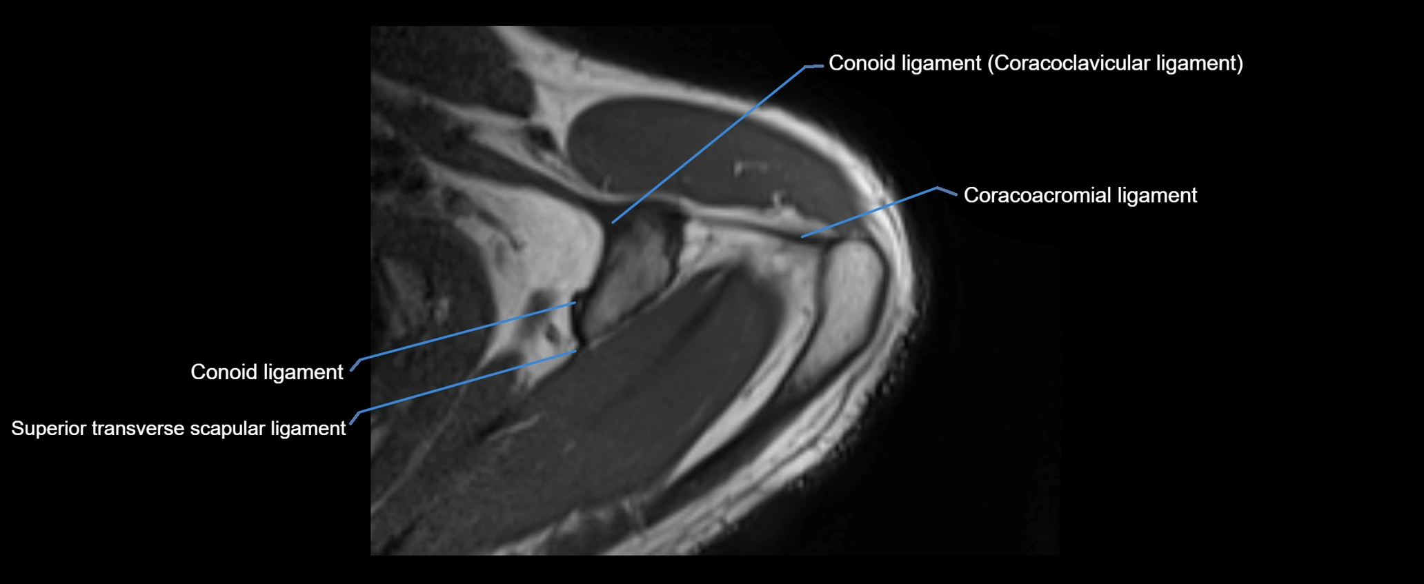 shoulder ligaments axial 3d 3t mri image-img-00005-00032.webp